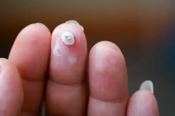 Image of white wart before cryopen treatment Stoulton