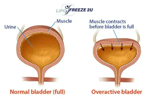diagram of overactive bladder treatment Stoulton