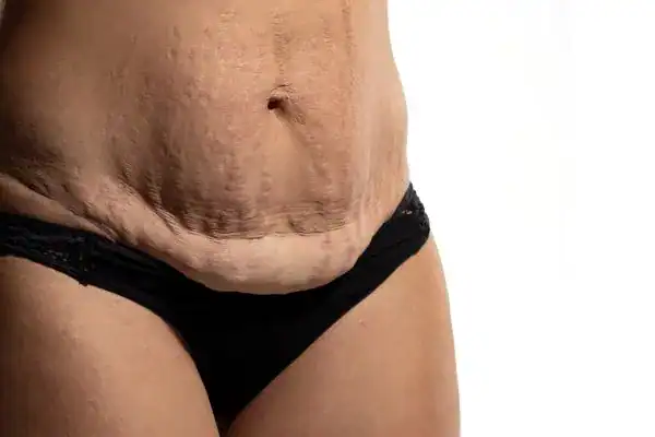 loose skin after weight loss injections Stoulton