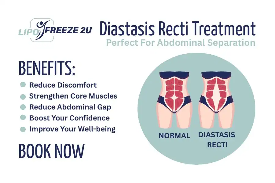 Benefits of body toning treatment Stoulton for Diastasis recti