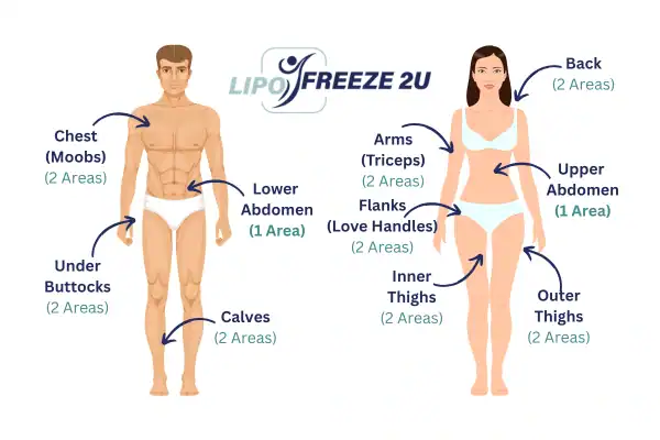 Areas you can have fat freezing treatment Stoulton