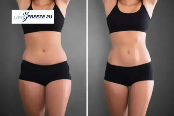 How Can LIPO FREEZE 2U Support Your Post-Pregnancy Body Recovery Stoulton?