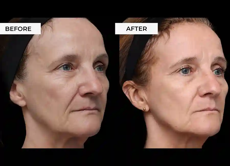 How Many RF Microneedling Sessions Will You Need to See a Difference Stoulton?