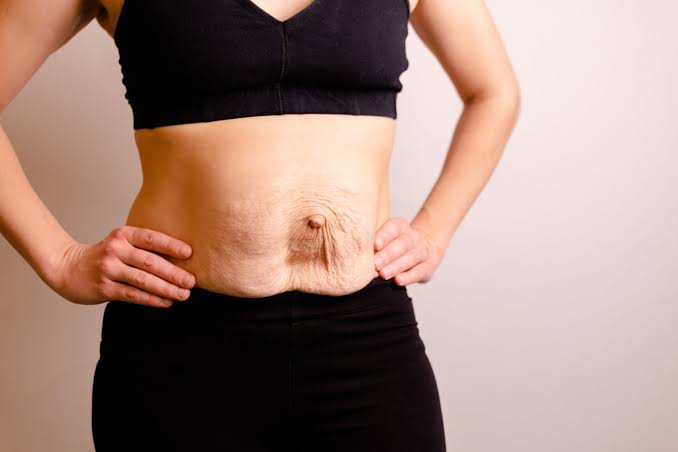 Is Surgery Really the Only Way to Repair Diastasis Recti Stoulton?